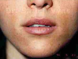 Lip Correction