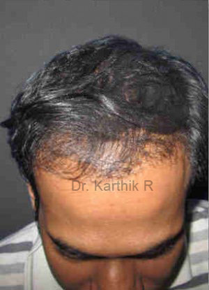 Hair Transplant