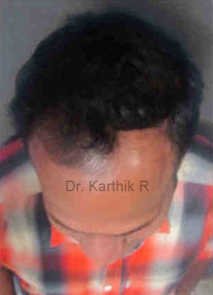 Hair Transplant