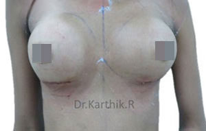 Breast Implants (Breast Augmentation)