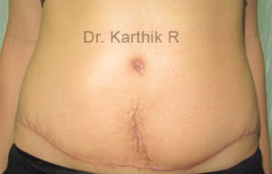 Tummy Tuck