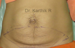 Tummy Tuck