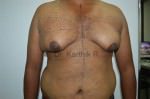 Gynecomastia (Puffy Nipples/ Male Chest Correction)