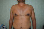 Gynecomastia (Puffy Nipples/ Male Chest Correction)