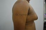 Gynecomastia (Puffy Nipples/ Male Chest Correction)