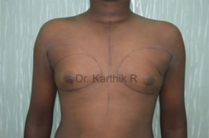 Gynecomastia (Puffy Nipples/ Male Chest Correction)