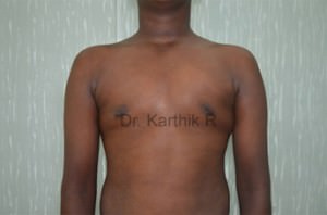 Gynecomastia (Puffy Nipples/ Male Chest Correction)