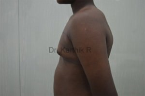 Gynecomastia (Puffy Nipples/ Male Chest Correction)