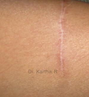 Scar Revision