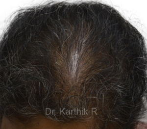 Dermaroller scalp