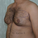 Gynecomastia (Puffy Nipples/ Male Chest Correction)