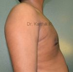 Gynecomastia (Puffy Nipples/ Male Chest Correction)