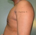 Gynecomastia (Puffy Nipples/ Male Chest Correction)