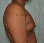 Gynecomastia (Puffy Nipples/ Male Chest Correction)