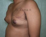 Gynecomastia (Puffy Nipples/ Male Chest Correction)