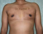 Gynecomastia (Puffy Nipples/ Male Chest Correction)