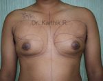 Gynecomastia (Puffy Nipples/ Male Chest Correction)