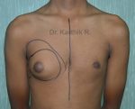 Gynecomastia (Puffy Nipples/ Male Chest Correction)