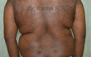 Liposuction Tummy and Back