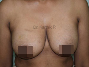 Breast Fat Fill (Breast Augmentation)