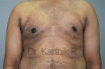 Gynecomastia (Puffy Nipples/ Male Chest Correction)