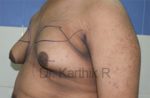 Gynecomastia (Puffy Nipples/ Male Chest Correction)