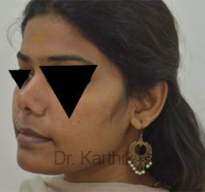 Rhinoplasty (Nose Corrections)