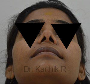 Rhinoplasty (Nose Corrections)