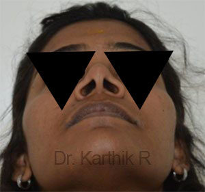 Rhinoplasty (Nose Corrections)