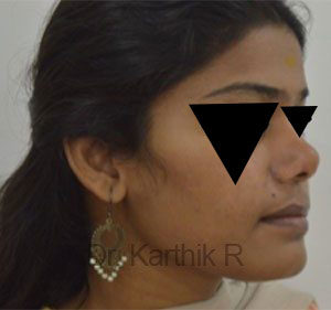 Rhinoplasty (Nose Corrections)