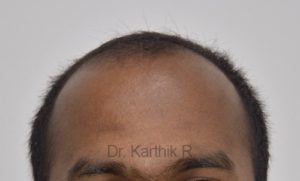 Hair Transplantation