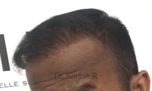 Hair Transplantation