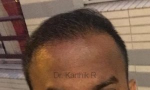 Hair Transplant