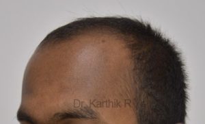 Hair Transplantation