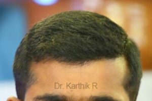 Hair Transplant