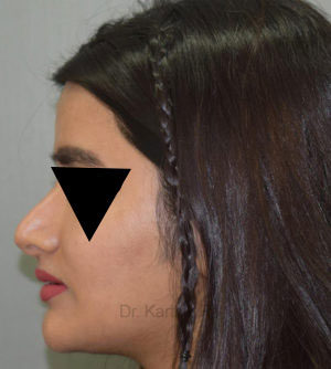 Rhinoplasty (Nose Corrections)