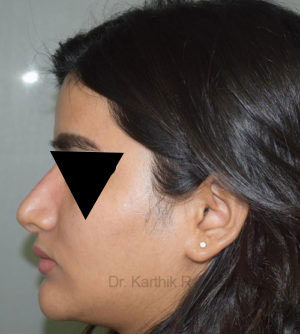 Rhinoplasty (Nose Corrections)