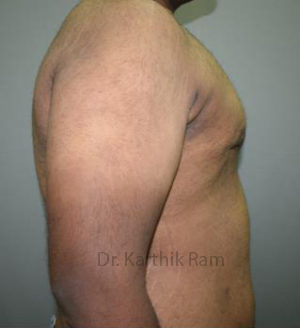 Gynecomastia (Puffy Nipples/ Male Chest Correction)