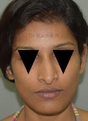 Rhinoplasty (Nose Corrections)