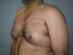 Gynecomastia (Puffy Nipples/ Male Chest Correction)