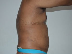 Liposuction Tummy and Back