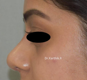 Rhinoplasty (Nose Corrections)