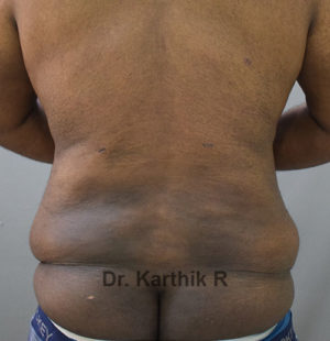 Liposuction Tummy and Back