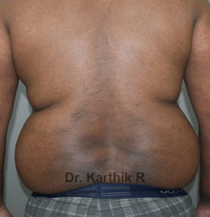 Liposuction Tummy and Back