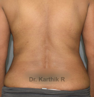 Liposuction Tummy and Back