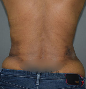 Liposuction Tummy and Back