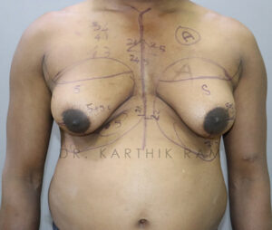 Gynecomastia (Puffy Nipples/ Male Chest Correction)