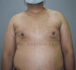 Gynecomastia (Puffy Nipples/ Male Chest Correction)