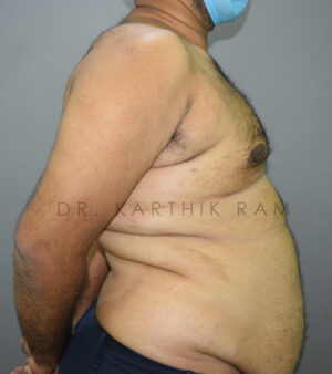 Gynecomastia (Puffy Nipples/ Male Chest Correction)