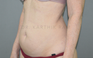 Liposuction Tummy and Back